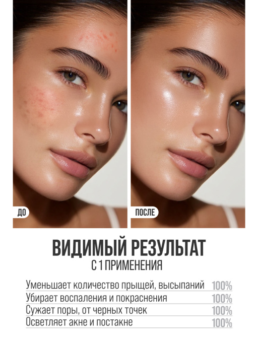 Сыворотка для лица от прыщей B3 2%+ZN 0,5%