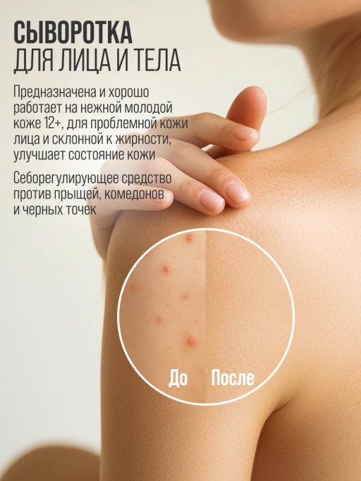 Сыворотка 7DAYS для лица от прыщей с Ниацинамидом и Цинком, набор 3 шт х 20 мл